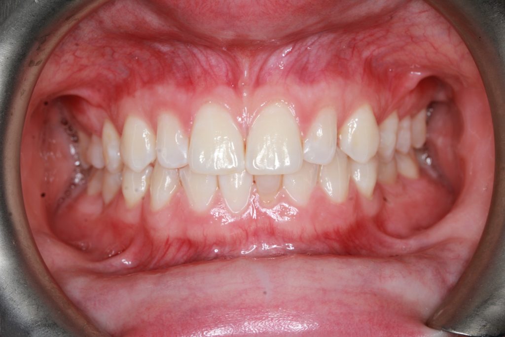 InOvation L MTM Orthodontist San Diego Clear Braces